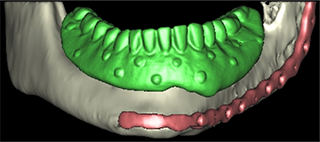 implantes dentales