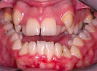 implantes dentales